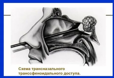 Удаление гипофиза операция