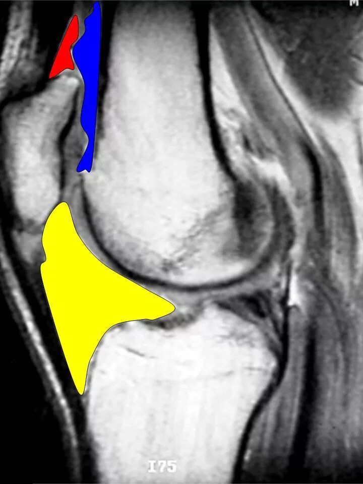 Отек гоффа коленного сустава. Болезнь Гоффа коленного сустава. Инфрапателлярный бурсит.