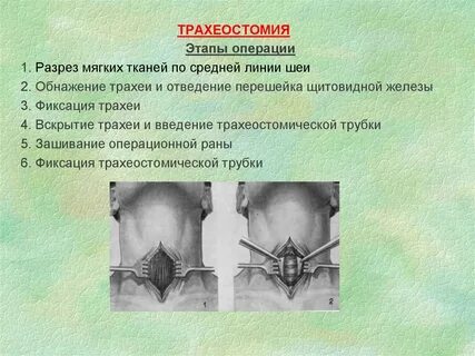 Трахеостомия