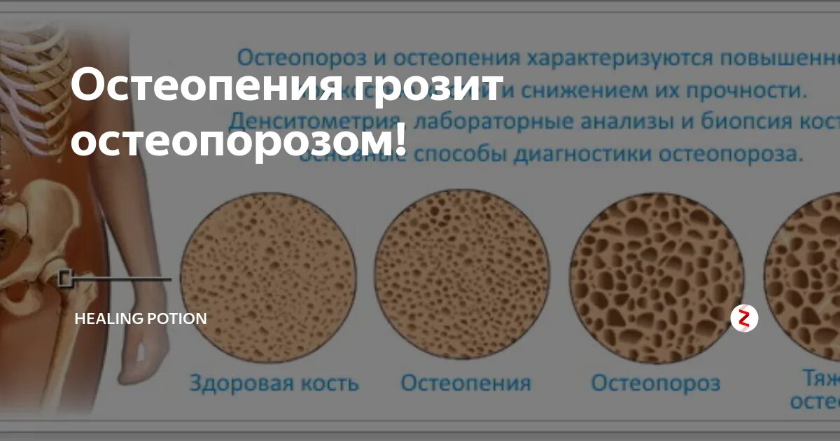 Что такое остеопения