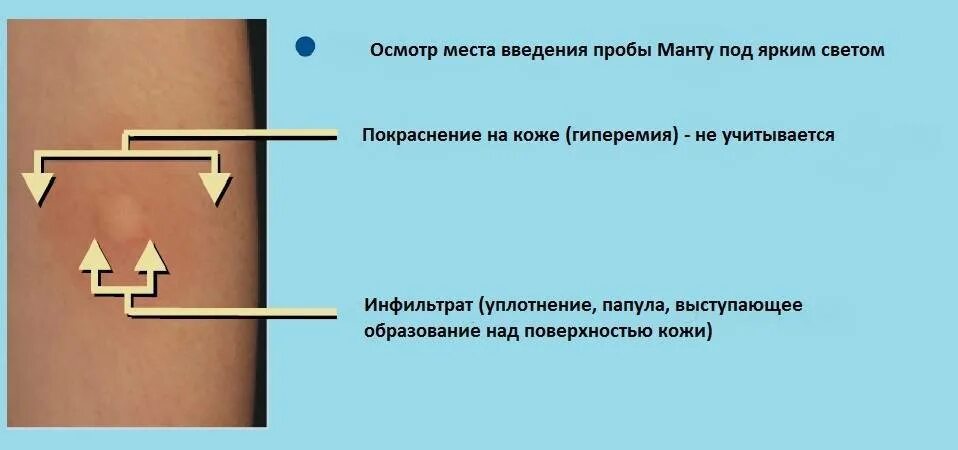 Как проверить манту у ребенка. Реакции манту папулы норма. реакция на туберкулез диаскинтест. проба манту оценка результата у детей 4 года.