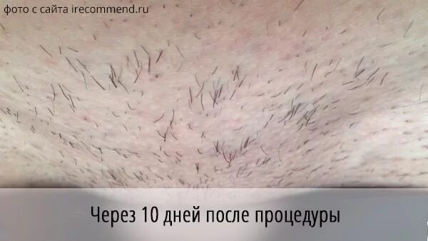 Electrolysis on Ingrown Hairs: Step by Step - YouTube
