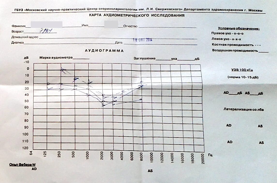 Возрастная норма слуха на аудиограмме. Аудиограмма 1 степень кондуктивной тугоухости. Тубоотит аудиограмма. Аудиограмма 4 степени тугоухости. Аудиограмма степени