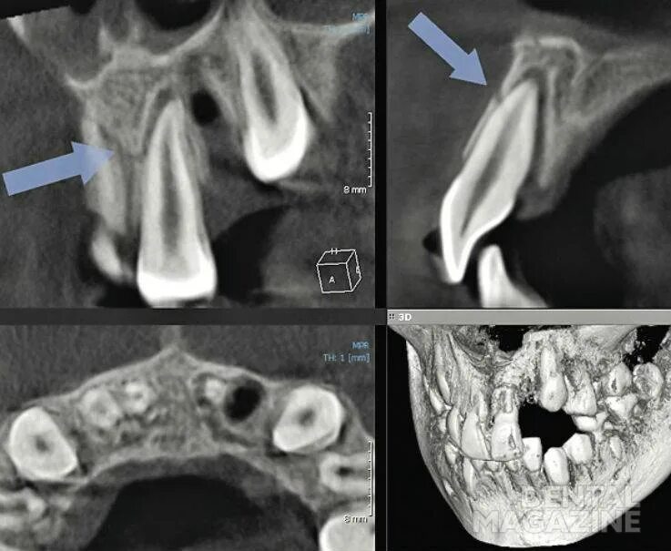 Вколоченный вывих зуба рентген. Вколоченный вывих зуба кт. Неполный вывих зуба рентген. Вколоченный вывих молочного зуба рентген.