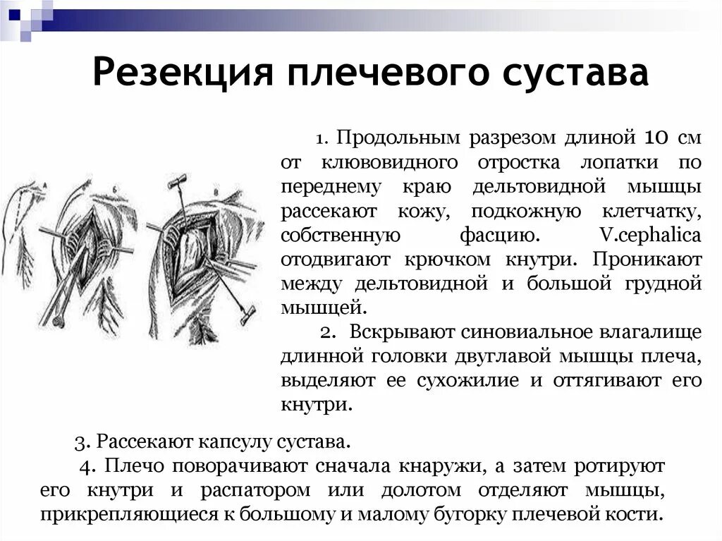 Артротомия плечевого сустава. Пункция плечевого сустава. Резекция и артротомия плечевого сустава.. Принципы операции на плечевом суставе. Прокол артротомия и резекция плечевого сустава. Топография плечевого сустава артротомия плечевого сустава.