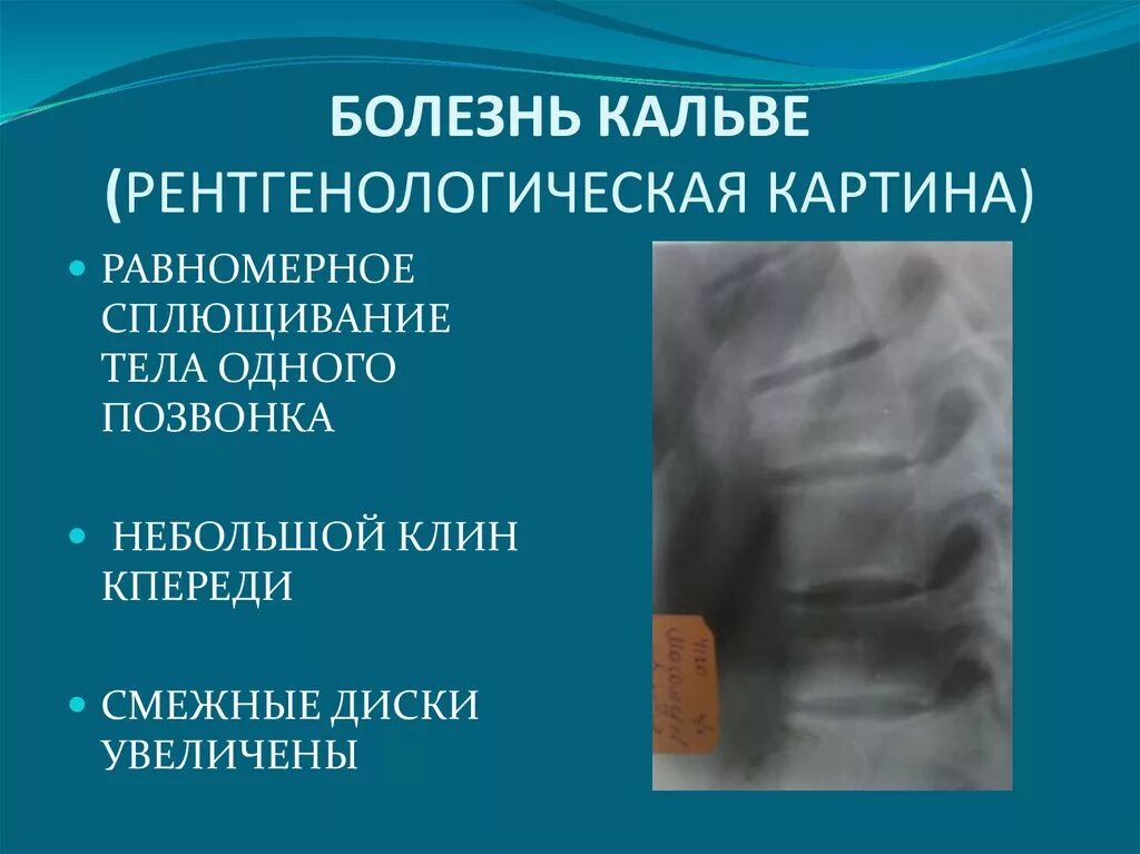 Дегенеративно-дистрофический синдром. Дегенеративно-дистрофические процессы это. Болезнь кальве позвоночника. Клинические рекомендации дегенеративные заболевания позвоночника 2021. Клинические рекомендации дегенеративные заболевания позвоночника 2021.