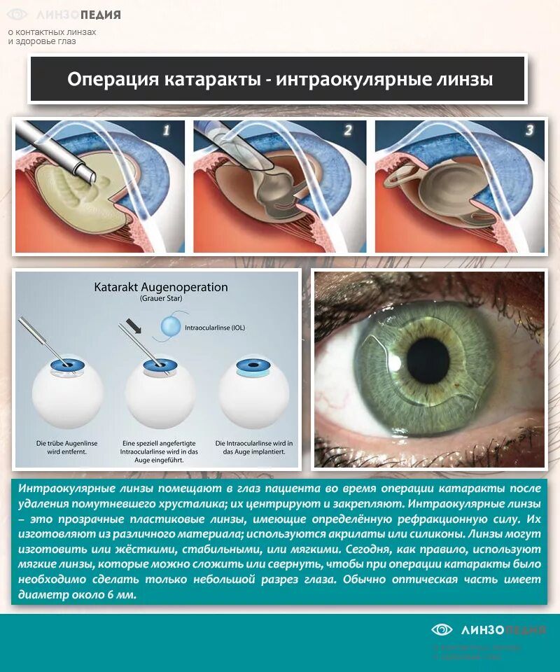 Как себя вести после операции катаракты. Спицевидная катаракта. Капсулярная врожденная катаракта. Интраокулярная коррекция зрения.