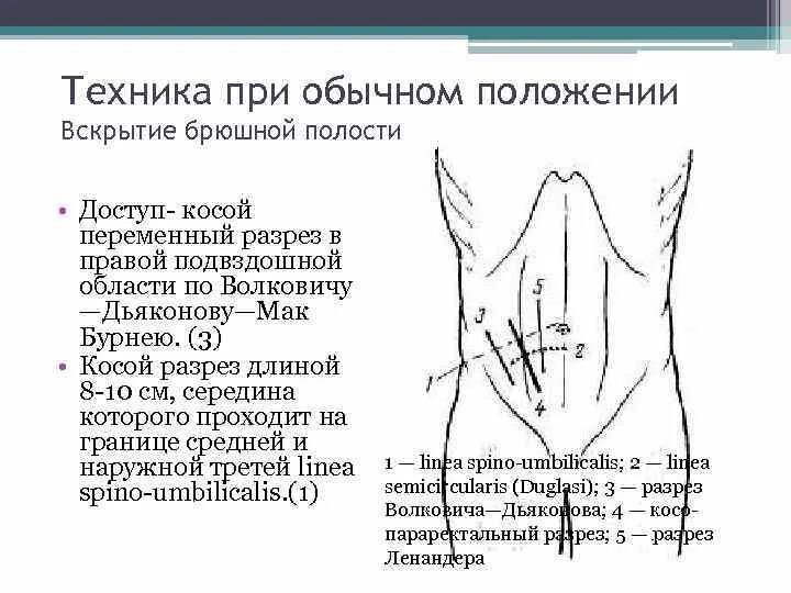 Точки аппендицита. Аппендэктомия разрез Волковича-Дьяконова. Разрез Мак-Бернея-Волковича-Дьяконова. Мак Бурнея Волковича Дьяконова. Аппендэктомия Волкович.