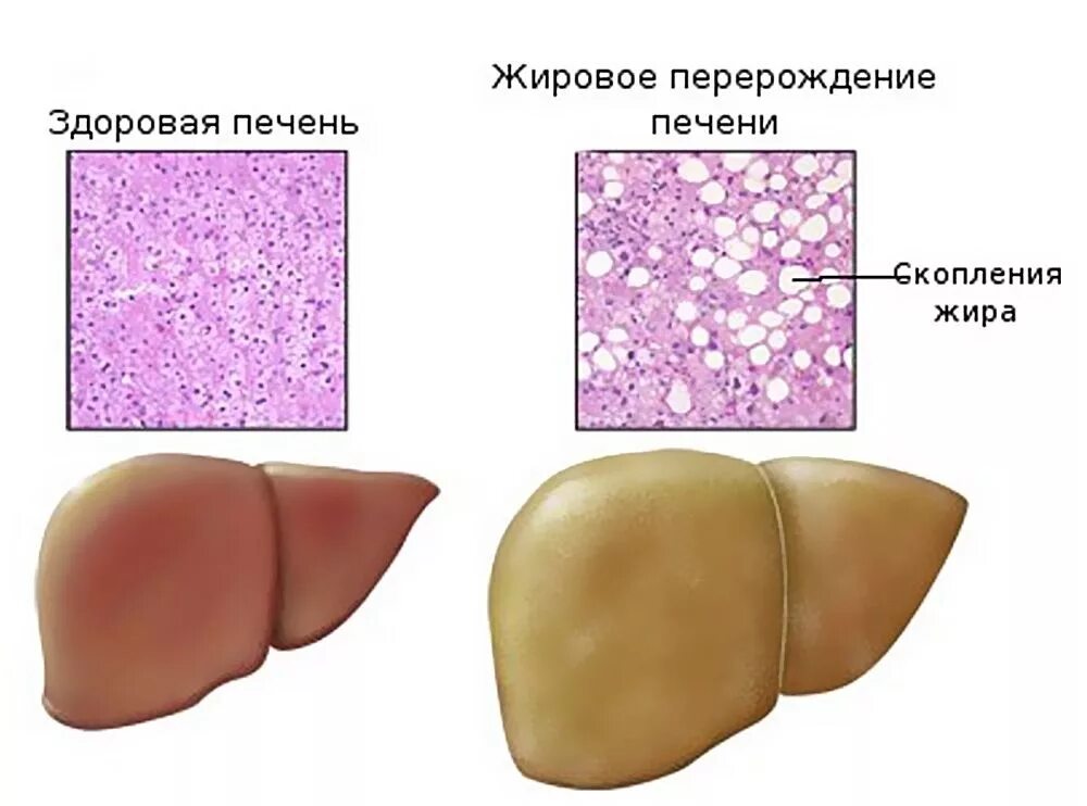 Проявления жировой дистрофии. Жировая дистрофия печени макропрепарат. ожирение печени гепатоз печени. жировой гепатоз печени макропрепарат. стеатоз печени макропрепарат.