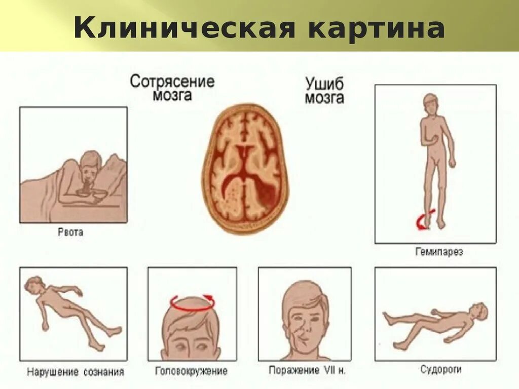 Легкое сотрясение головы. Как определить сотрясение. Клинические симптомы сотрясения головного мозга.