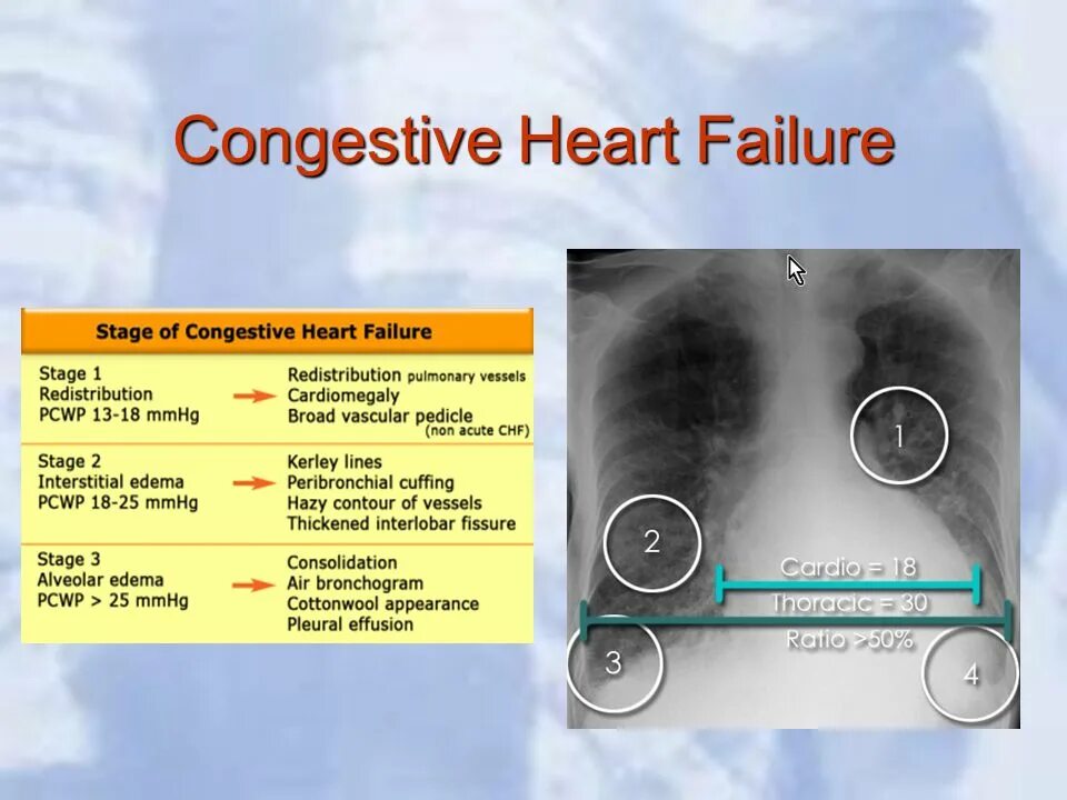 Nyha classification of heart failure. Jackson dangerous live танцоры. Failed stage. Wrestlemania 21 arena. Failed stage.
