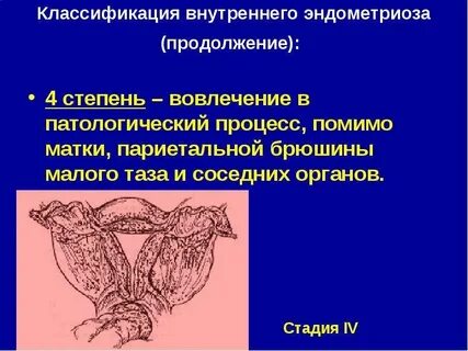 Что значит внутренний эндометриоз