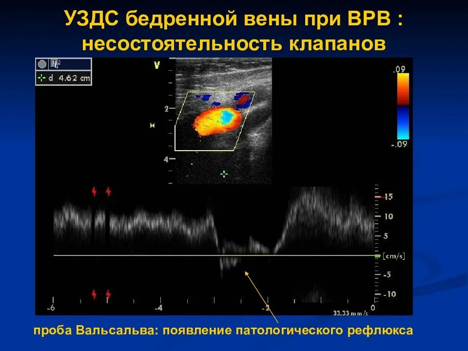 Доплер нижних конечностей. Ультразвуковое ангиосканирование дуплексное сканирование. Ультразвуковое дуплексное сканирование (УЗДС). УЗИ допплерография артерий нижних конечностей. Ультразвуковая дуплексная сканирования нижних конечностей.