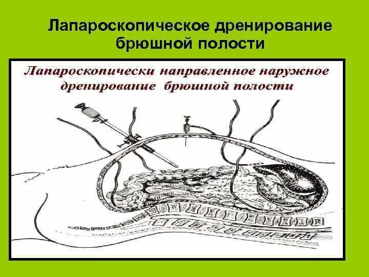 Санация и дренирование брюшной полости. Санация и дренирование брюшной полости