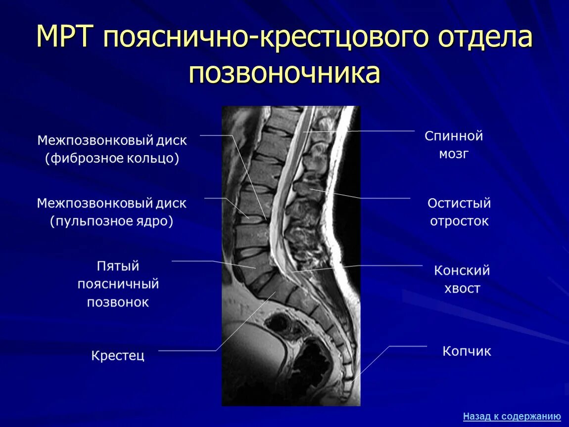 Остеохондроз поясничного крестцового отдела на мрт. МСКТ пояснично-крестцового отдела. Мрт крестцово-копчикового отдела позвоночника. Поясрично крестовый отдел. Крестовой отдел позвоночника