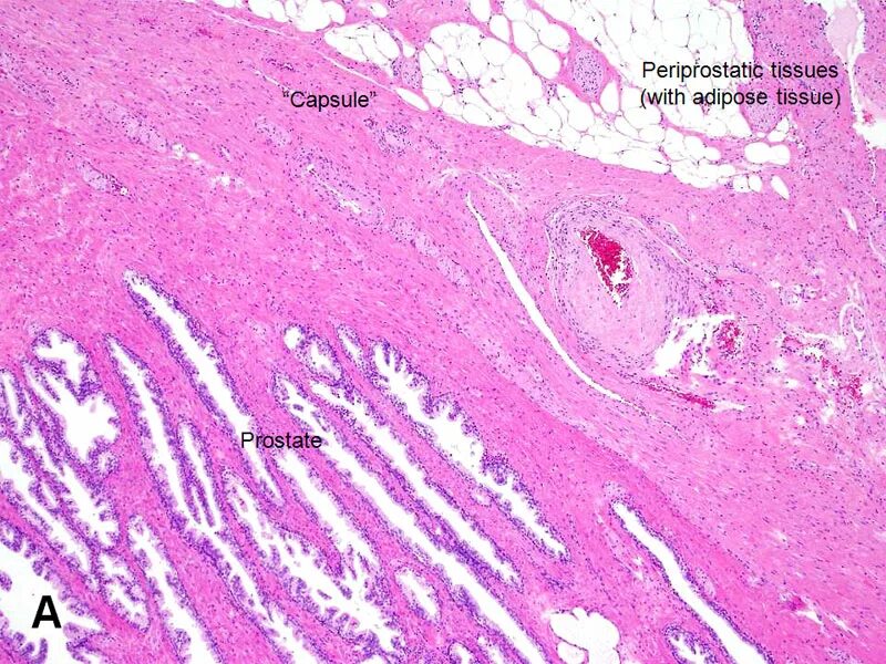 Предстательная железа капсула. Extraprostatic Extension.