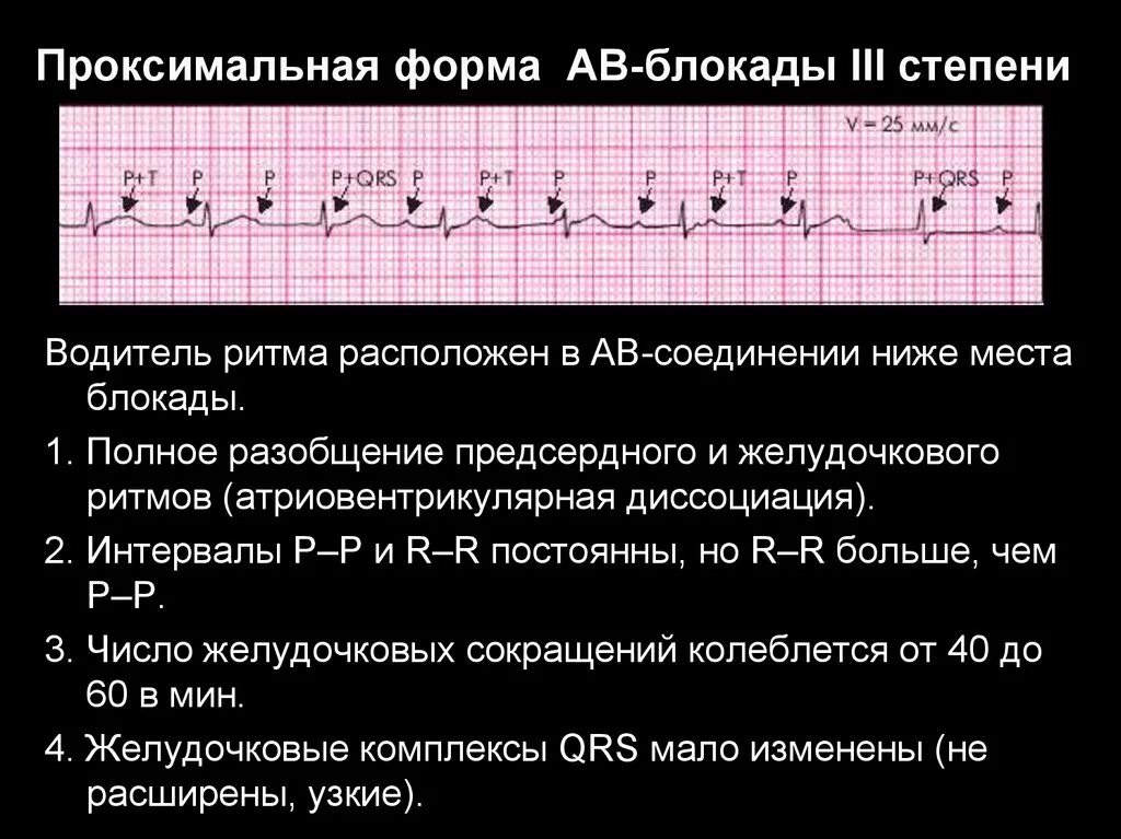 Полная атриовентрикулярная блокада. АВ блокада 3 степени проксимальный и дистальный. АВ блокада 3 степени полная проксимальная. Атриовентрикулярная блокада на ЭКГ. Полная атриовентрикулярная блокада 3 степени на ЭКГ.