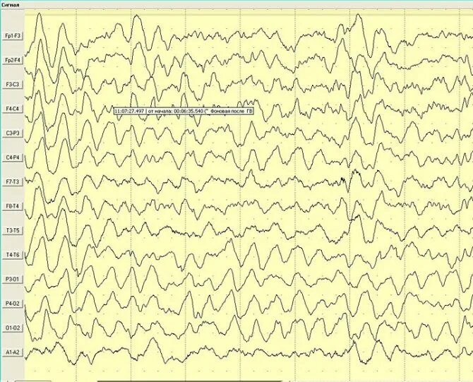 ЭЭГ (электроэнцефалограмма) головного мозга. Альфа ритм ЭЭГ. Альфа ритм ЭЭГ при эпилепсии. Альфа активность на ЭЭГ. Пароксизмальная активность мозга