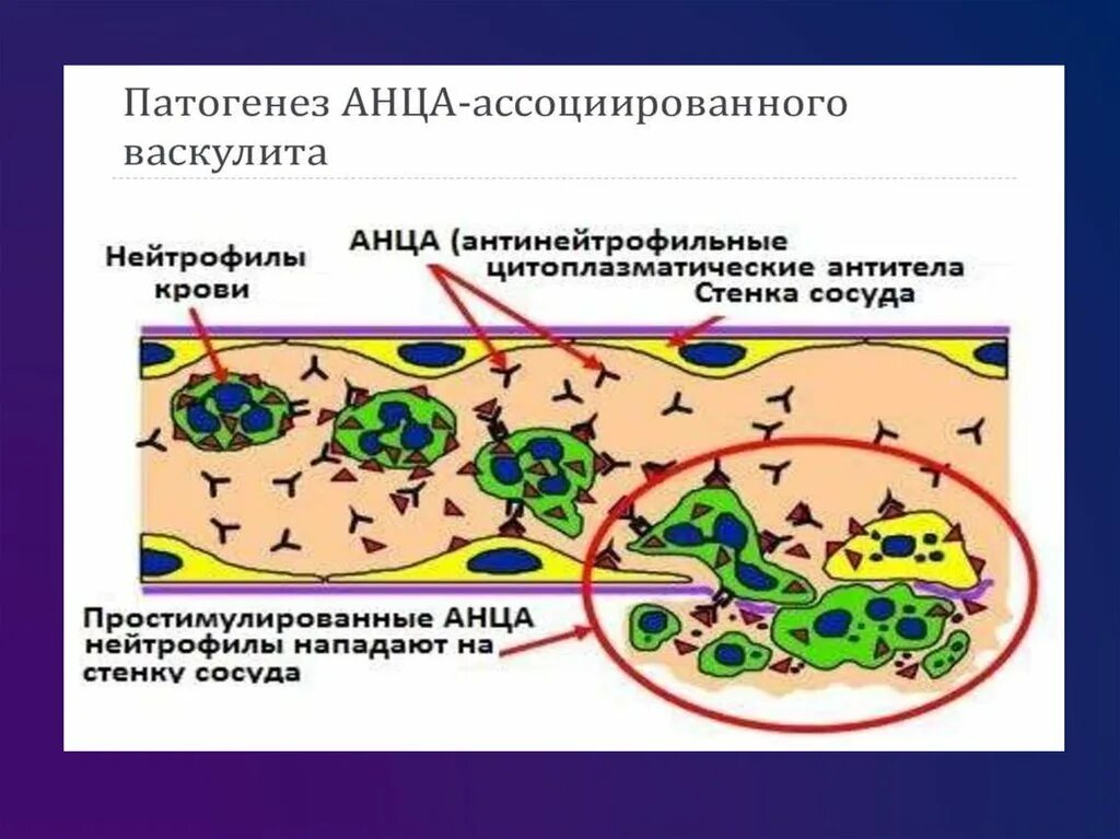 АНЦА-ассоциированные васкулиты патогенез. АНЦА-ассоциированных системных васкулитов. АНЦА васкулит патогенез. Системные васкулиты патогенез иммунология. Васкулит патогенез