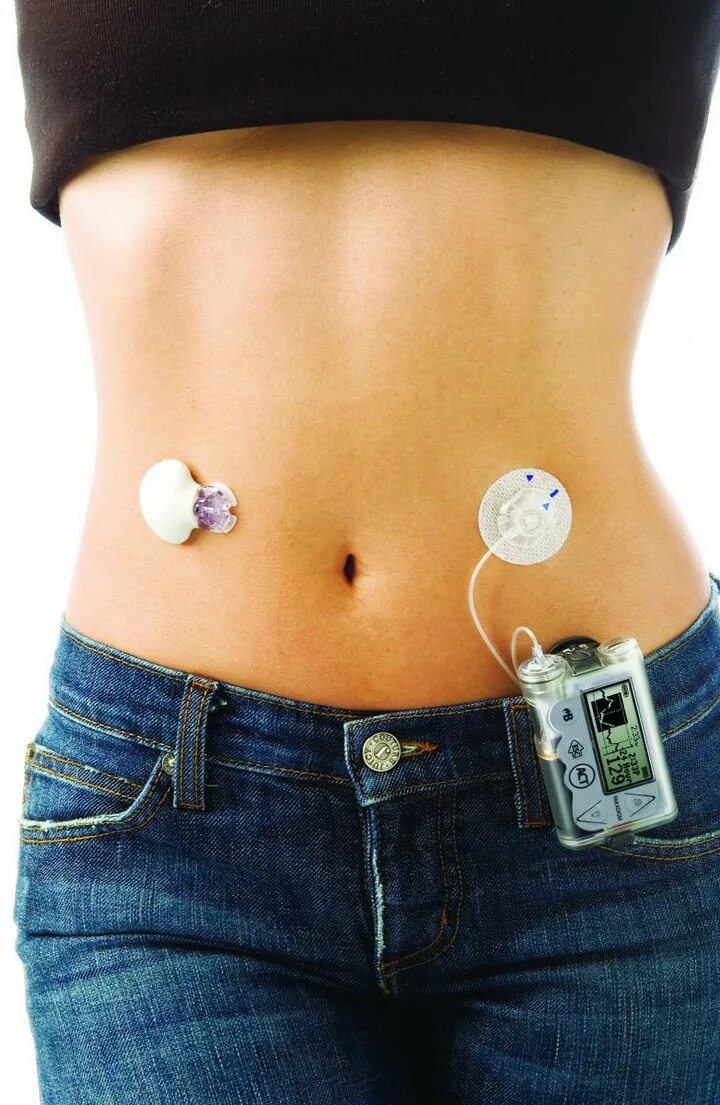 Инсулиновый насос. Медтроник 720 помпа инсулиновая. Инсулиновая помпа медтроник 754. Помпа для диабетиков 2. Помпа медтроник 722.