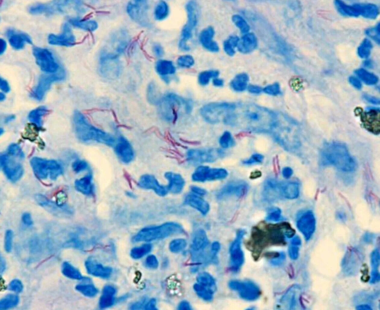 Микобактерии туберкулеза микроскопия. Mycobacterium leprae микроскопия. Окраска по Цилю-Нильсену Mycobacterium leprae. Микобактерии по Цилю Нильсену.