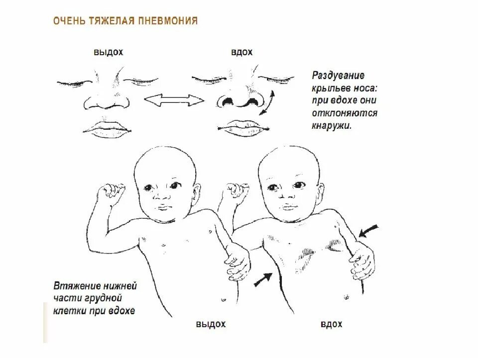 Грудная клетка ребенка 2 года. Втяжение межреберных промежутков у новорожденного. Втяжение уступчивых мест грудной клетки у детей. Воспаление легких у грудного ребенка. Втяжение грудной клетки при пневмонии у детей.