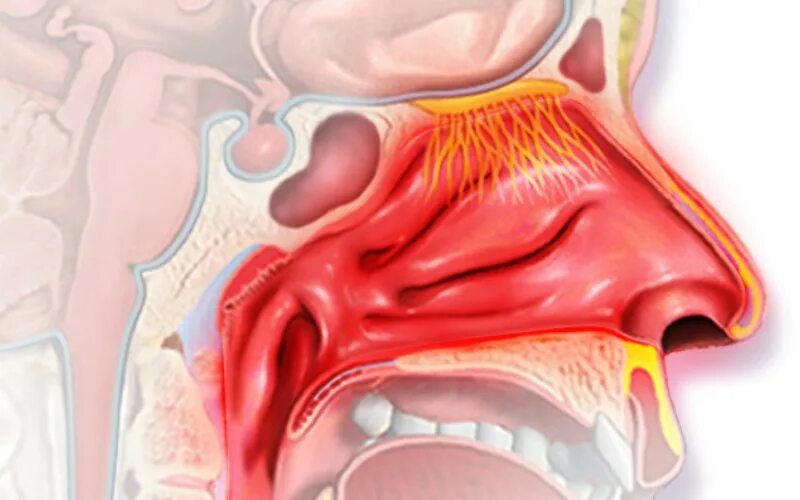 Катаральный ринит слизистая. Острый катаральный ринит
