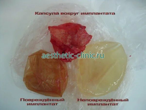 Как выглядит имплант после операции TEMPORARY TEETH TooTH REPAIR KIT * Cosmetic Repair * 30 teeth. IT REALLY WORKS!