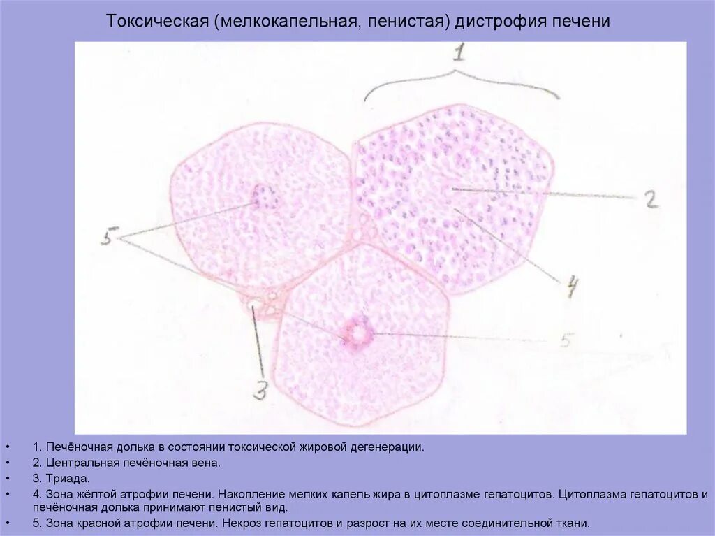 Печень микропрепарат описание. Цирроз печени гистология. Токсическая дистрофия печени микропрепарат. Жировая дистрофия печени гистология обозначения. Токсическая дистрофия печени гистология.