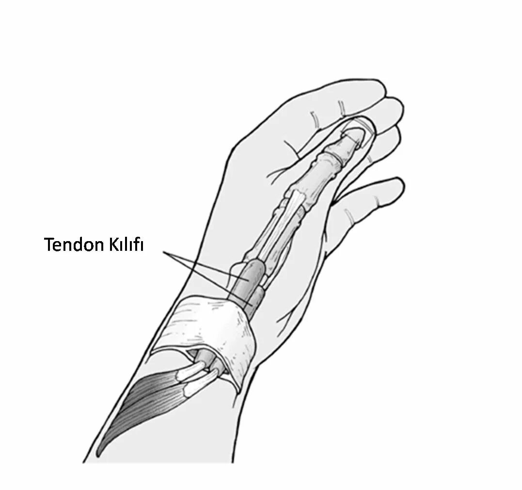 Теносиновит сухожилия кисти. Тендовагинит де Кервена. Теносиновит де Кервена большого пальца руки. Болезнь де Кервена лучезапястного сустава.