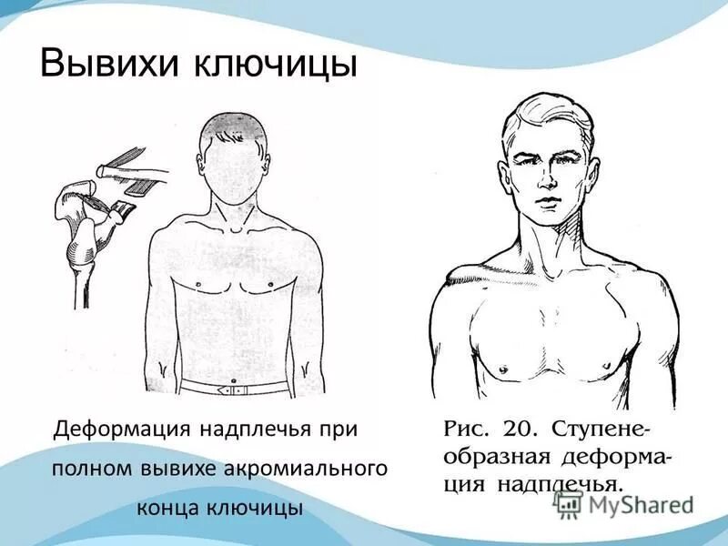 Вывих ключицы карта вызова