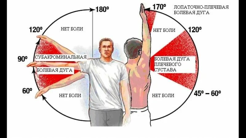 Резкая сильная боль в плечевом суставе. Болит плечо при поднятии руки. Плечевой сустав болит при поднятии руки. Болит плечо при поднятии руки вверх. Дуга Дауборна.