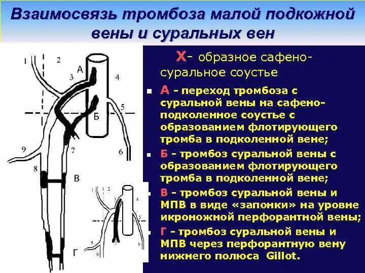 Флеботромбоз малой подкожной вены. Тромбоз суральной вены. Классификация острых венозных тромбозов. Тромбофлебит общей бедренной вены.