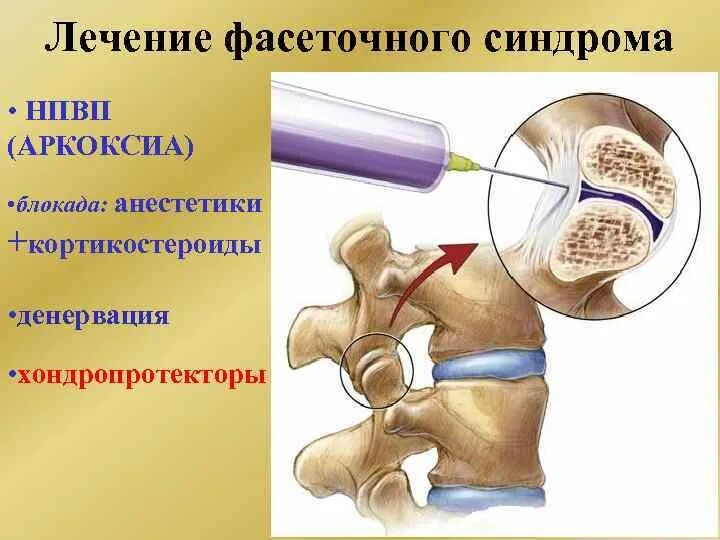 Фасеточная блокада. Фасеточные суставы поясничного отдела позвоночника. Фасеточный сустав шейного отдела. Фасеточные межпозвонковые суставы. Фасеточный сустав 5 позвонка.