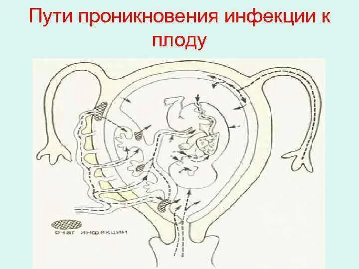 Передача от матери к плоду. Пути проникновения инфекции к плоду. Пути проникновения внутриутробной инфекции. Пути внутриутробного инфицирования плода. Восходящий путь инфицирования плода.