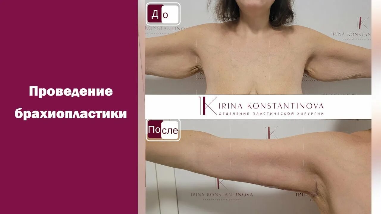 Пластика рук до и после Результаты липофилинга Пластический хирург Мороз Светлана Евгеньевна