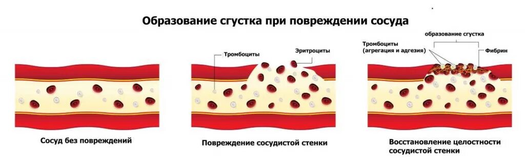 Метод коагуляции поврежденных сосудов. Поврежденная стенка сосуда. Разрыв стенки сосуда. Повреждение кровеносных сосудов. Ранение кровеносных сосудов.