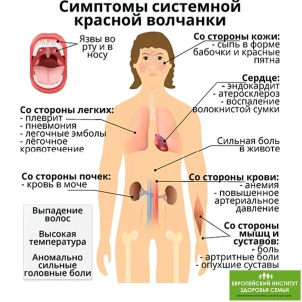 Красный осложнение. Красная волчанка симптомы симптомы. Кожный синдром системной красной волчанки. Системная красная волчанка simptomi. Системная красная волчанка кожные симптомы.