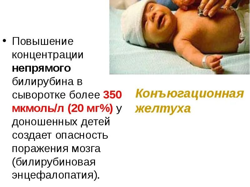 Билирубин при рождении. Желтушка у новорожденных 300 билирубин. билирубин у новорожденных 200. желтушка у новорожденных билирубин 20. билирубин 20 у новорожденного.