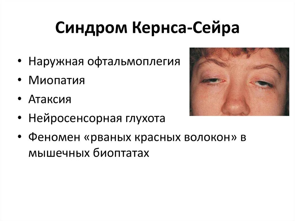 Исключение синдрома. Синдром офтальмоплегия (наружная, внутренняя, тотальная). Синдром Кернса-Сейра симптомы. Синдром наружной офтальмоплегии.