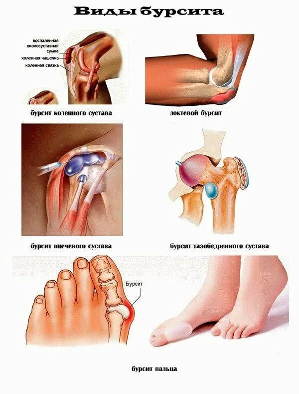 .Бурсит бурсит коленного сустава. Гнойный бурсит коленного. Препателлярный бурсит. Эффективное лечение бурсита локтевого
