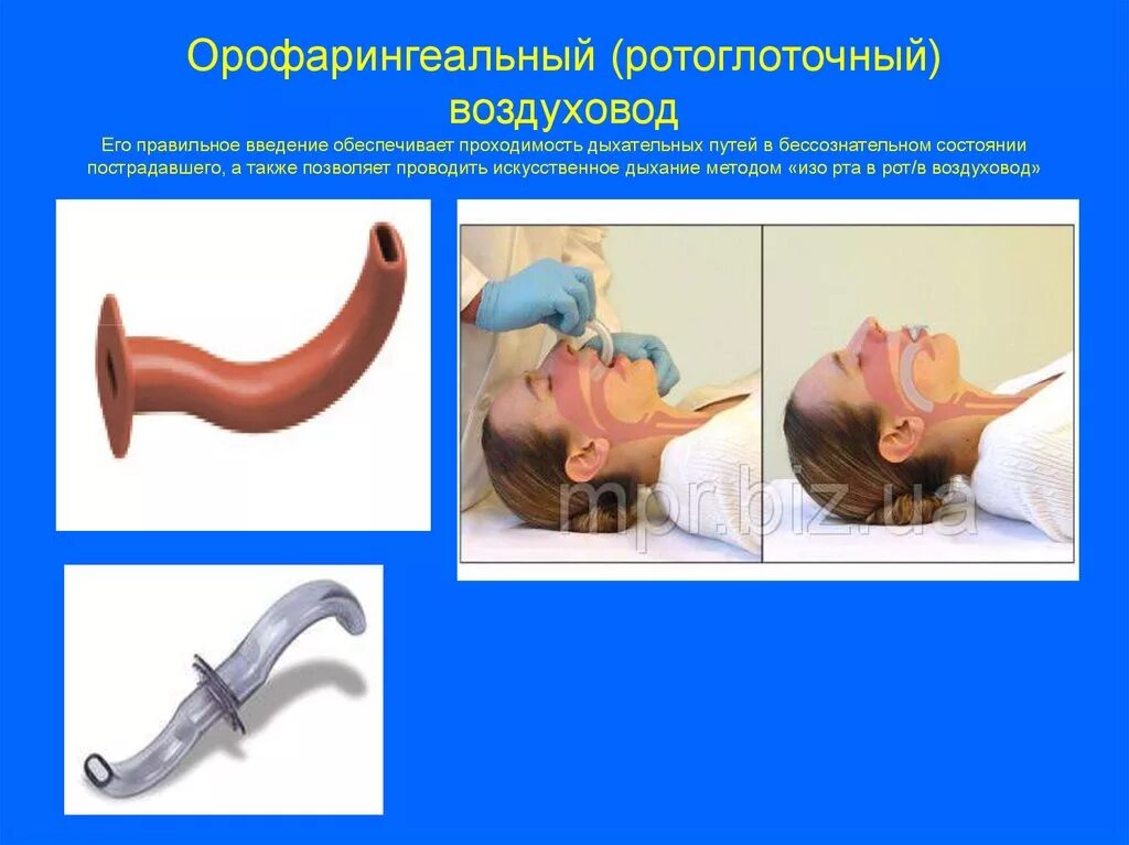 введение орофарингеального воздуховода. проведение воздуховода. воздухообмен вытяжка 100. обеспечение проходимости дыхательных путей (воздуховод, мешок амбу). введение воздуховода через рот.