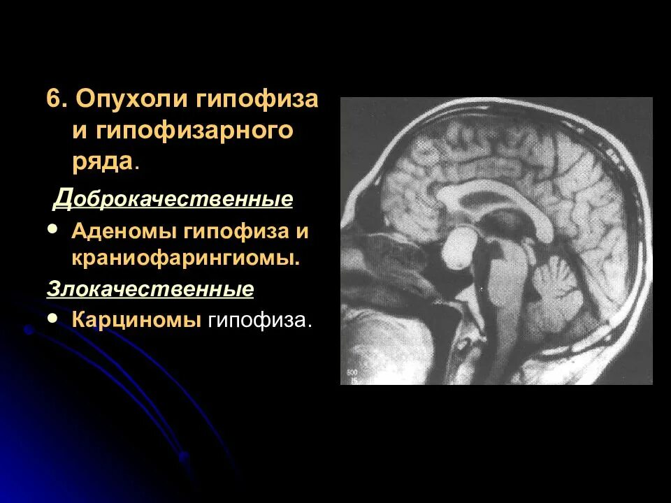 Гормонопродуцирующая аденома гипофиза. Опухоль головного мозга аденома гипофиза. Параселлярная аденома гипофиза. Базальная аденома гипофиза.