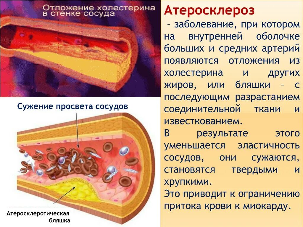 Атеросклеротическое поражение артерий. Поражение сосудистой стенки.