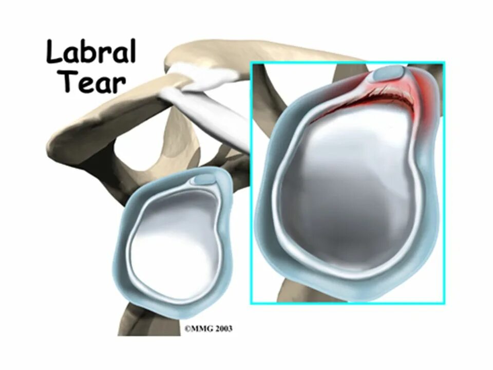 суставная губа гленоида плечевого сустава. повреждение слэп плечевого сустава мрт. суставная губа плечевого сустава. Slap синдром плечевого сустава. операция банкарта плечевого сустава.