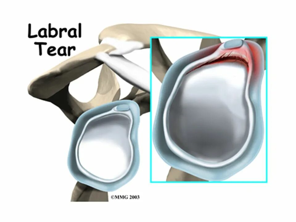Плечевая губа суставная разрыв