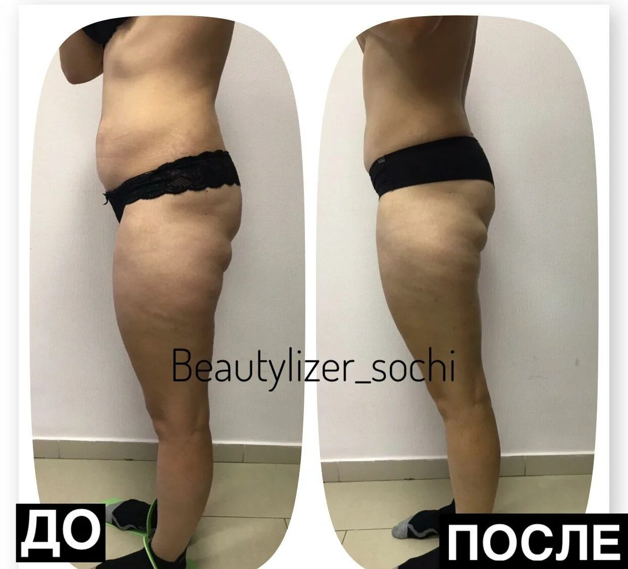 Коррекция фигуры до после. Студия коррекции фигуры. beautylizer до после. студия коррекции фигуры фото. коррекция фигуры с помощью татуировки.