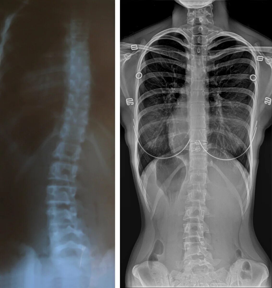 Левосторонний сколиоз рентген. Сколиоз 2 степени снимок. Сколиоз s1. Кт позвоночника сколиоз 2 степени.
