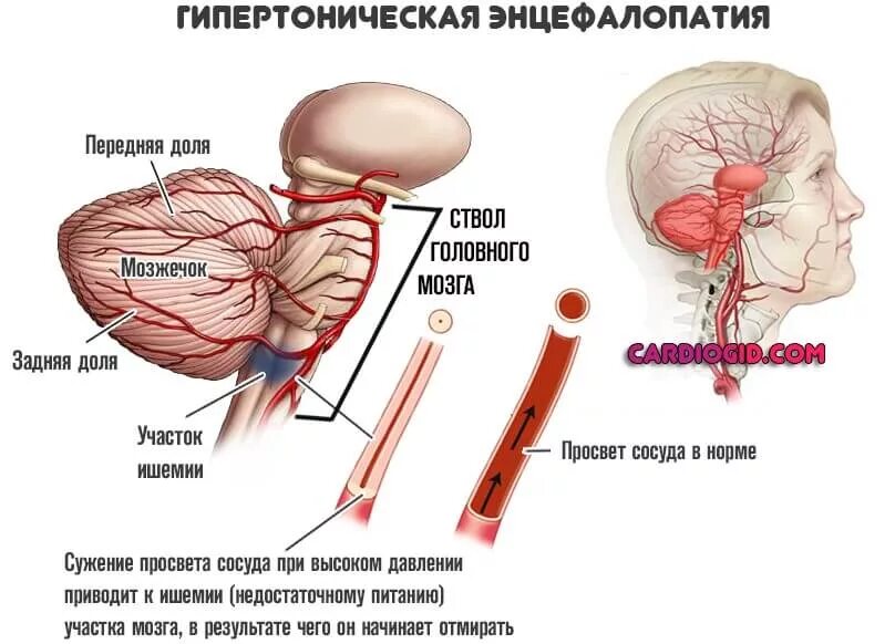 Помочь сосудам головы. Гипертензивная энцефалопатия патогенез. Микро инсульт головного мозга.