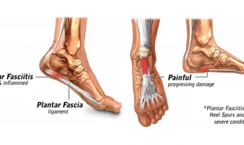 Фасциит стопы. Плантарный апоневроз стопы. Подошвенный апоневроз пяточная шпора. Плантарная фасция стопы. Плантарный апоневроз пятки.
